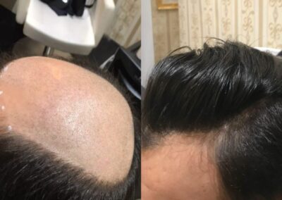 Vorher-Nachher-Vergleich, bei dem der haarlose Oberkopf eines Mannes mit einer MicroLines-Haarverdichtung von Hairdreams kaschiert wurde.