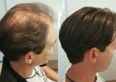 Vorher-Nachher-Vergleich, bei dem der lichte Oberkopf eines Mannes mit einer MicroLines-Haarverdichtung von Hairdreams kaschiert wurde.