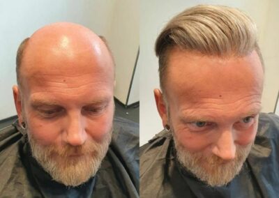 Vorher-Nachher-Vergleich, bei dem der haarlose Oberkopf eines Mannes mit einer MicroLines-Haarverdichtung von Hairdreams kaschiert wurde.